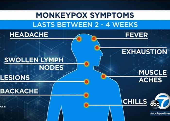 Monkeypox Symptoms